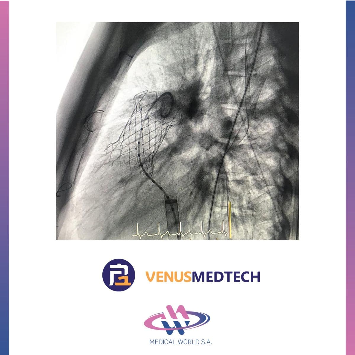 Reemplazo Valvular Percutáneo - Dr. Rivarola Marcelo Rivarola
